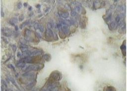 Immunohistochemistry-Paraffin: CA125/MUC16 Antibody (X75) [NB600-1468] - Analysis in antigen in serosal ovarian adenocarcinoma.