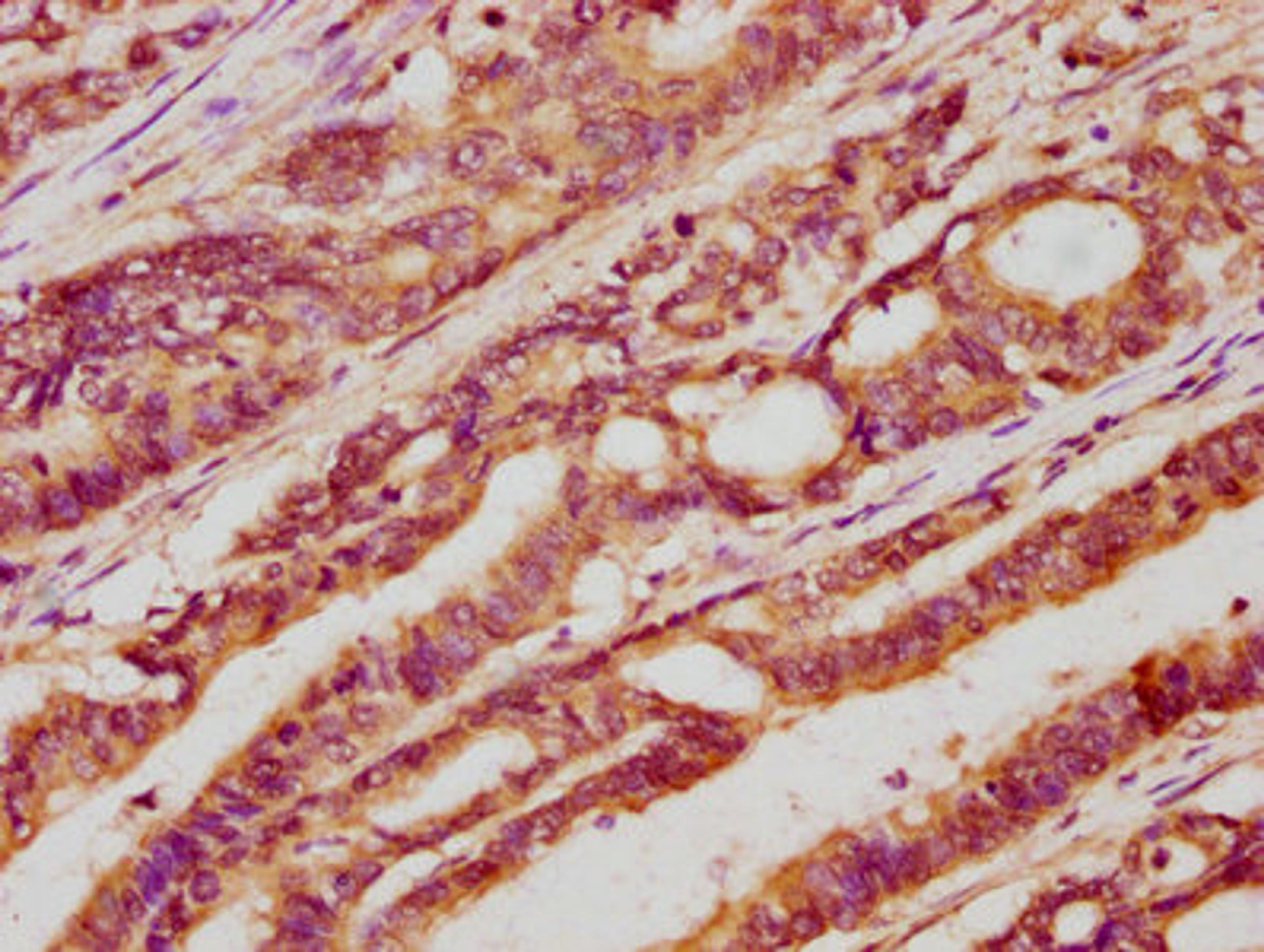 IHC image of CSB-PA012906LA01HU diluted at 1:400 and staining in paraffin-embedded human colon cancer performed on a Leica BondTM system. After dewaxing and hydration, antigen retrieval was mediated by high pressure in a citrate buffer (pH 6.0). Section was blocked with 10% normal goat serum 30min at RT. Then primary antibody (1% BSA) was incubated at 4°C overnight. The primary is detected by a biotinylated secondary antibody and visualized using an HRP conjugated SP system.