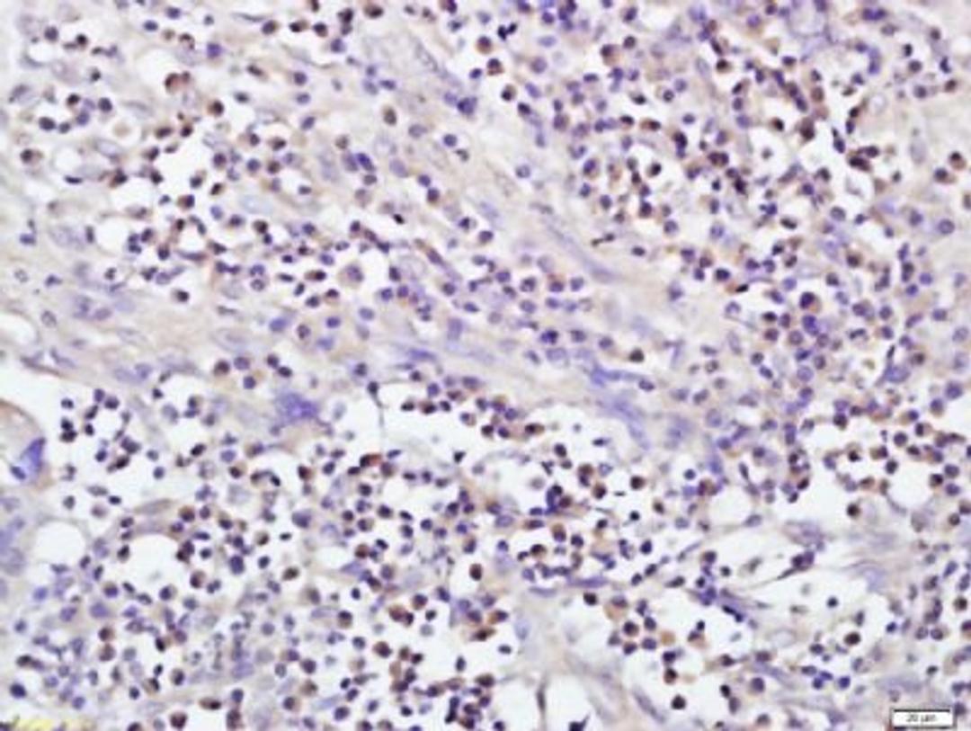 Immunohistochemical staining of human stomach carcinoma tissue using NAT8L antibody.