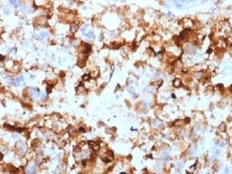 IHC testing of FFPE human gastric carcinoma with CA19-9 antibody. Required HIER: boil tissue sections in 10mM citrate buffer, pH 6.0, for 10-20 min.