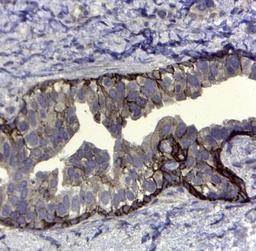 Immunohistochemistry-Paraffin: CD44, variant 5 Antibody (VFF-8) [NB100-65533] - Human breast cancer tissue with Mouse anti Human CD44v5 antibody.