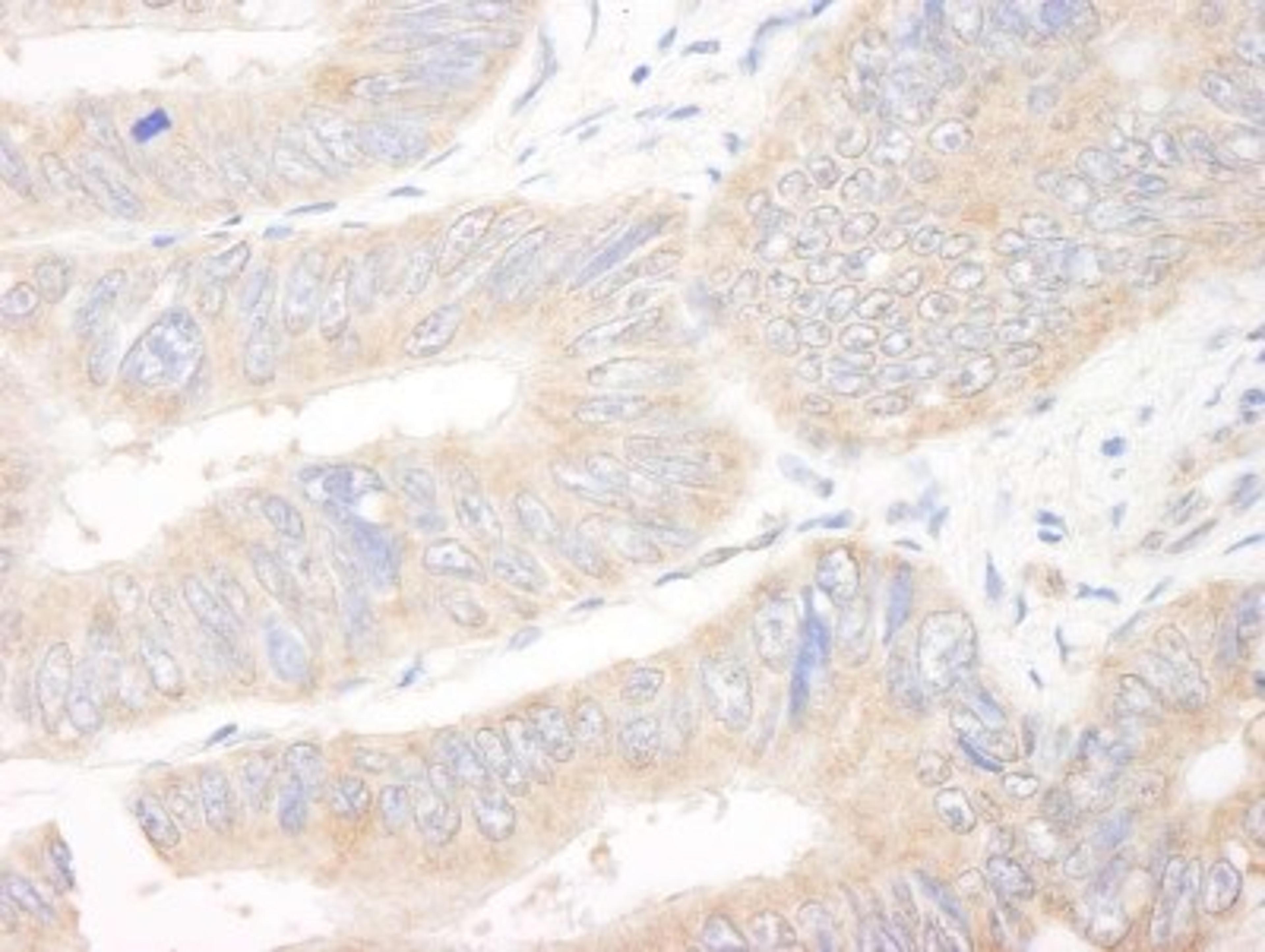 Immunohistochemistry-Paraffin: CIP2A Antibody [NB100-68264] - Human colon carcinoma. Antibody used at a dilution of 1:200 (1ug/ml).