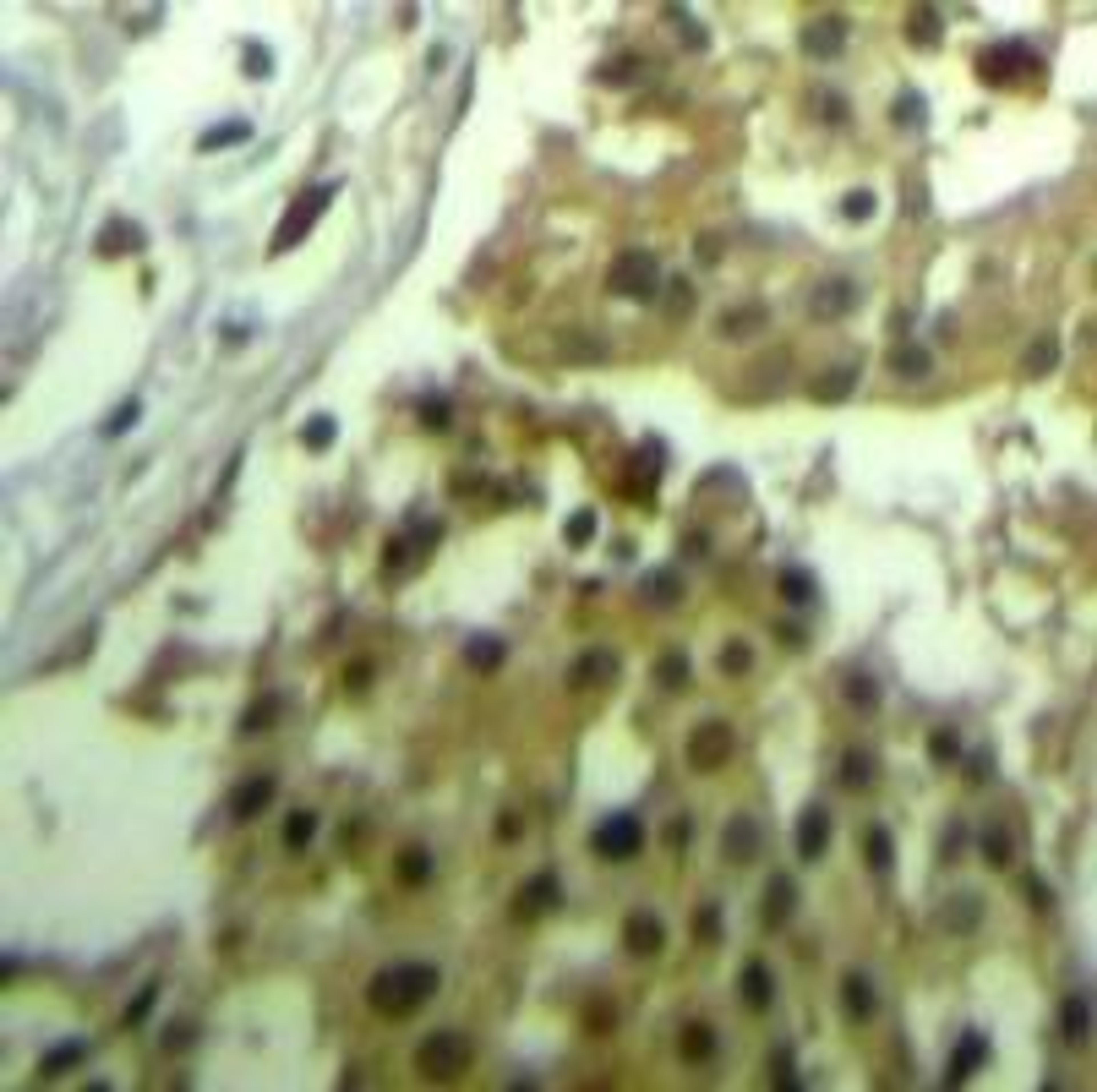 Immunohistochemical analysis of paraffin-embedded human breast carcinoma tissue using CDC2 (Ab-19).