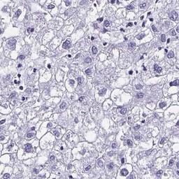 Immunohistochemistry: KCNT1 Antibody [NBP2-32496] - liver cancer