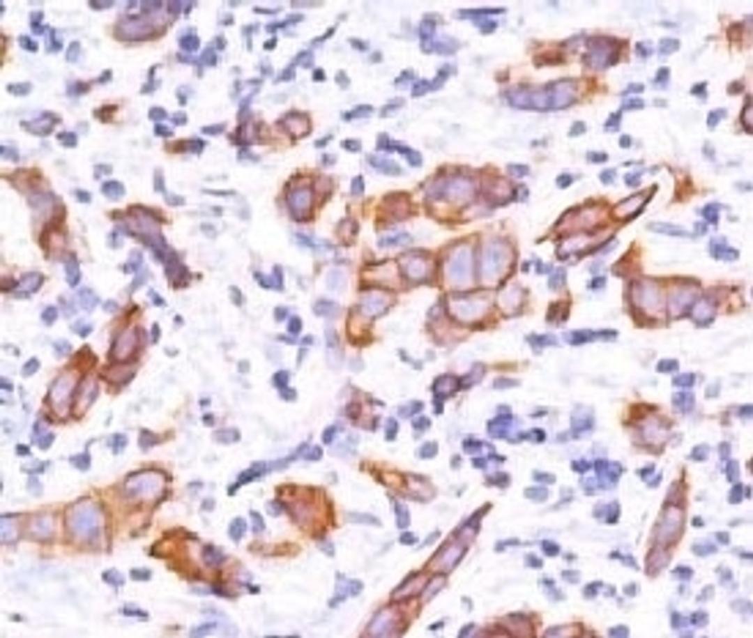 IHC testing of breast invasive carcinoma and HER2 antibody (2KRI7).