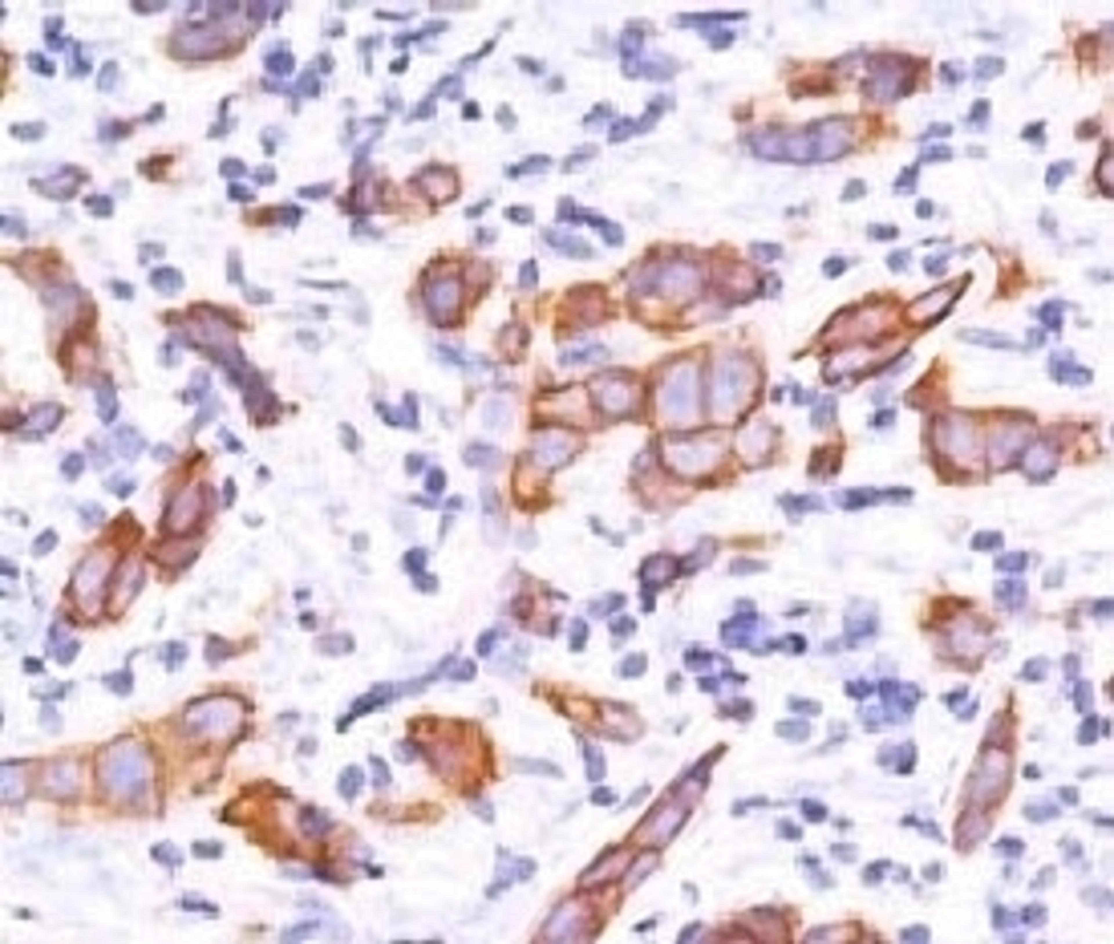 IHC testing of breast invasive carcinoma and HER2 antibody (2KRI7).