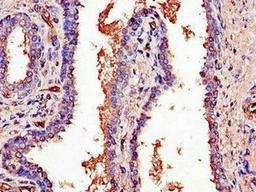Immunohistochemistry of paraffin-embedded human prostate cancer using CSB-PA685351LA01HU at dilution of 1:100