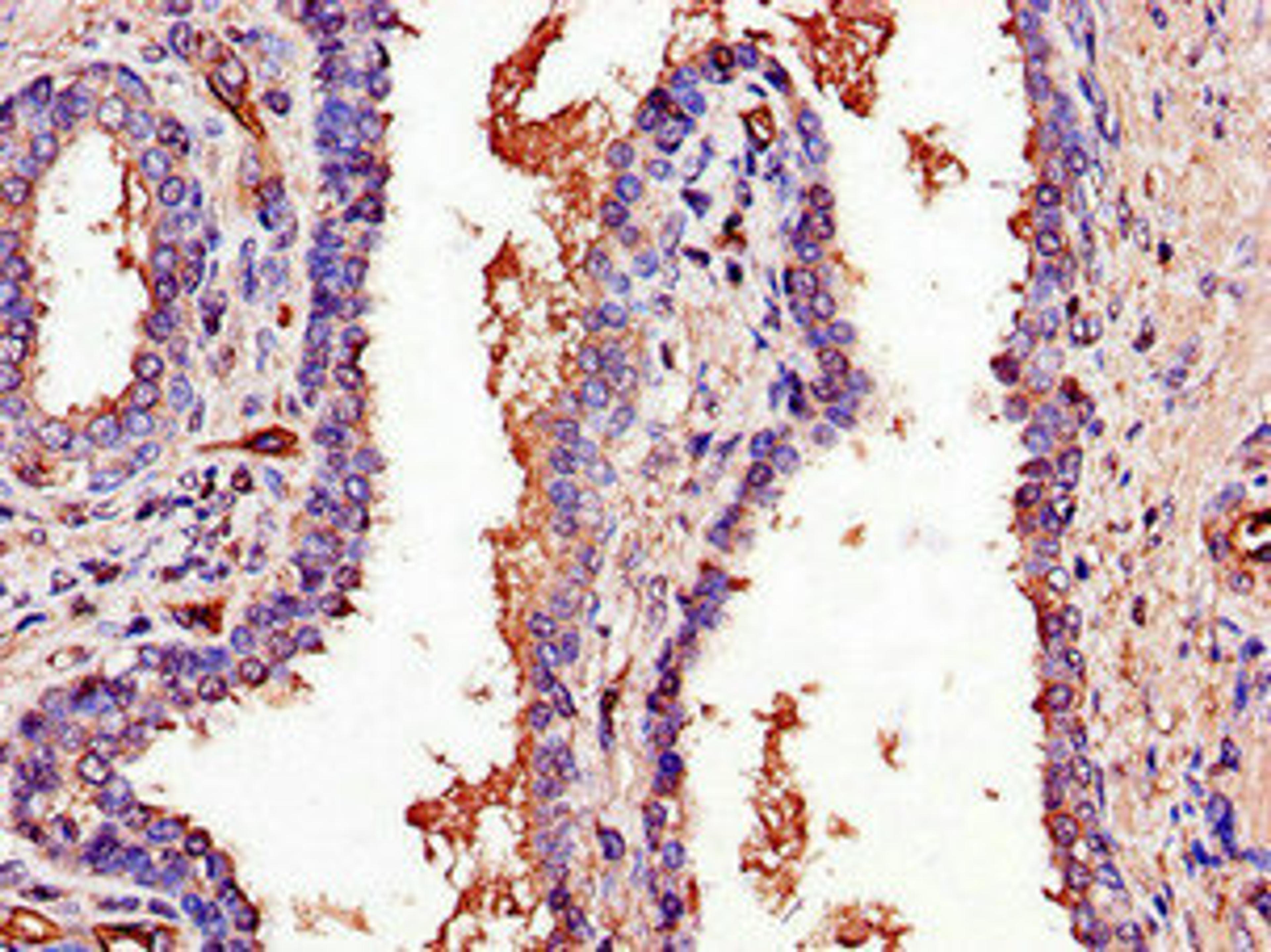 Immunohistochemistry of paraffin-embedded human prostate cancer using CSB-PA685351LA01HU at dilution of 1:100