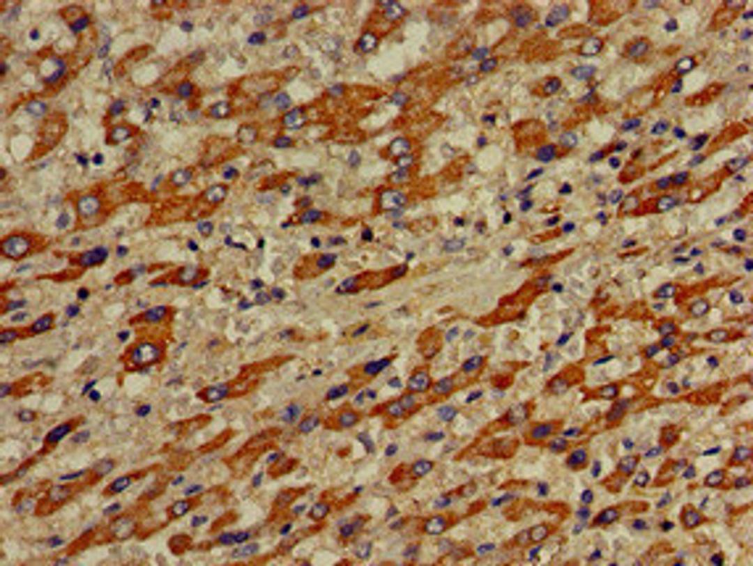 Immunohistochemistry of paraffin-embedded human liver cancer using CSB-PA850260LA01HU at dilution of 1:100