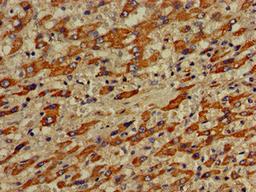 Immunohistochemistry of paraffin-embedded human liver cancer using CSB-PA850260LA01HU at dilution of 1:100