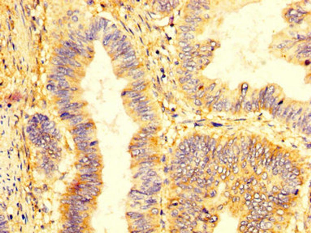 IHC image of CSB-PA012352LA01HU diluted at 1:400 and staining in paraffin-embedded human colon cancer performed on a Leica BondTM system. After dewaxing and hydration, antigen retrieval was mediated by high pressure in a citrate buffer (pH 6.0). Section was blocked with 10% normal goat serum 30min at RT. Then primary antibody (1% BSA) was incubated at 4°C overnight. The primary is detected by a biotinylated secondary antibody and visualized using an HRP conjugated SP system.