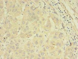 Immunohistochemistry of paraffin-embedded human liver cancer using CSB-PA643574LA01HU at dilution of 1:100