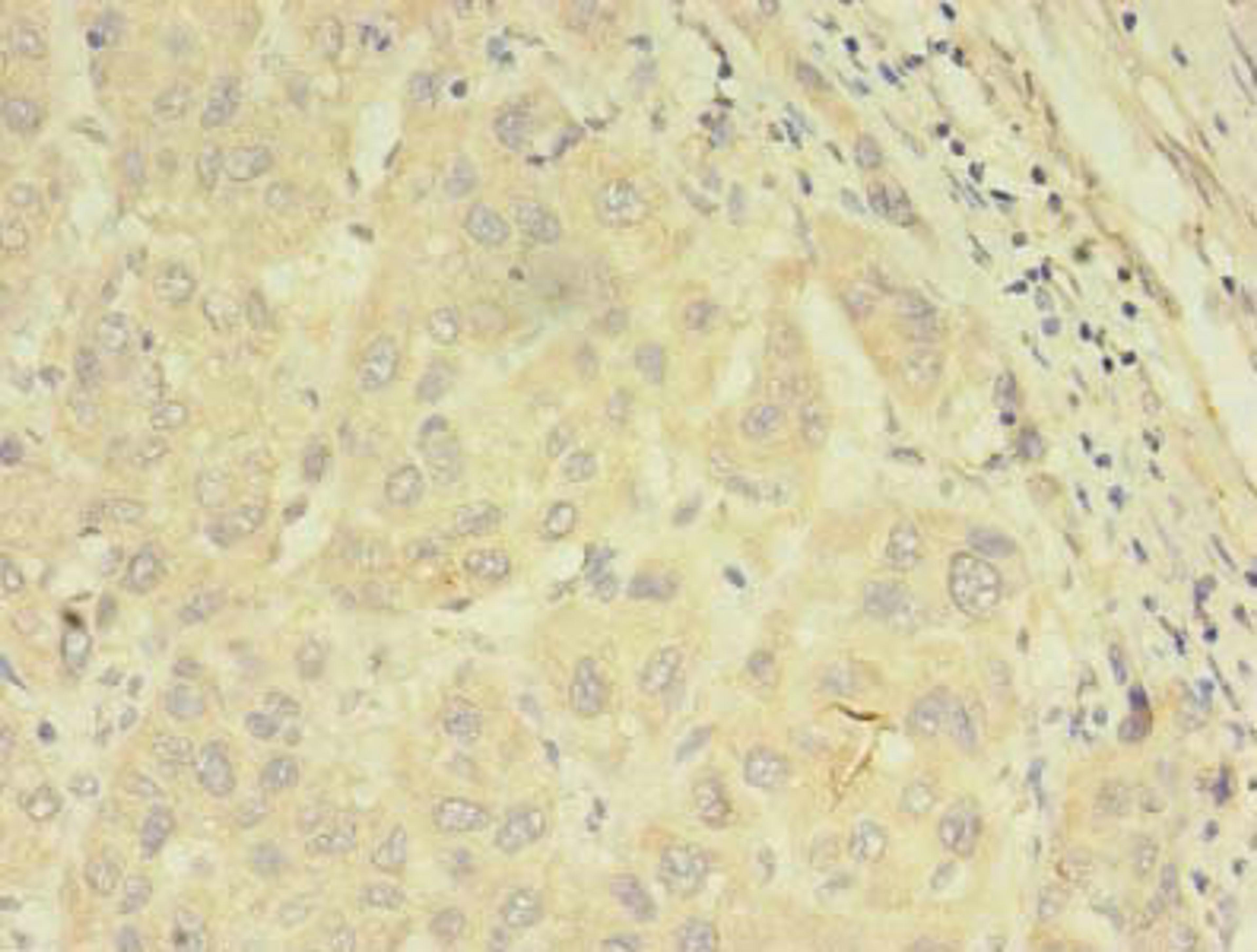 Immunohistochemistry of paraffin-embedded human liver cancer using CSB-PA643574LA01HU at dilution of 1:100