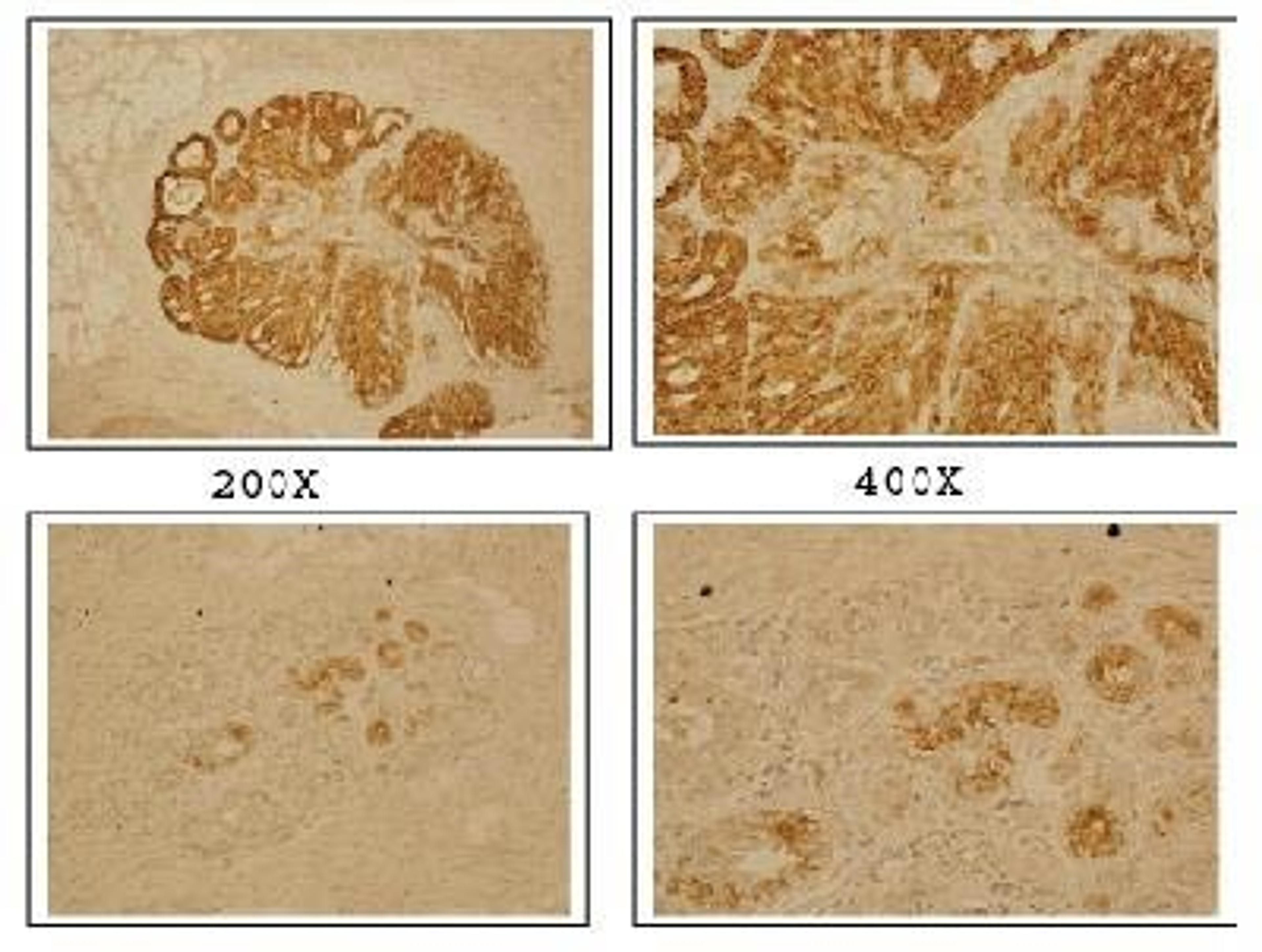 Immunohistochemistry: BP1 Antibody [NB100-481] - Top Panel: BP1 antibody detected in breast cancer cells. Bottom Panel: Staining of normal breast cancer cells.