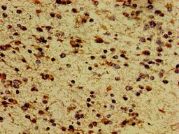 Immunohistochemistry of paraffin-embedded human glioma using CSB-PA013562LA01HU at dilution of 1:100