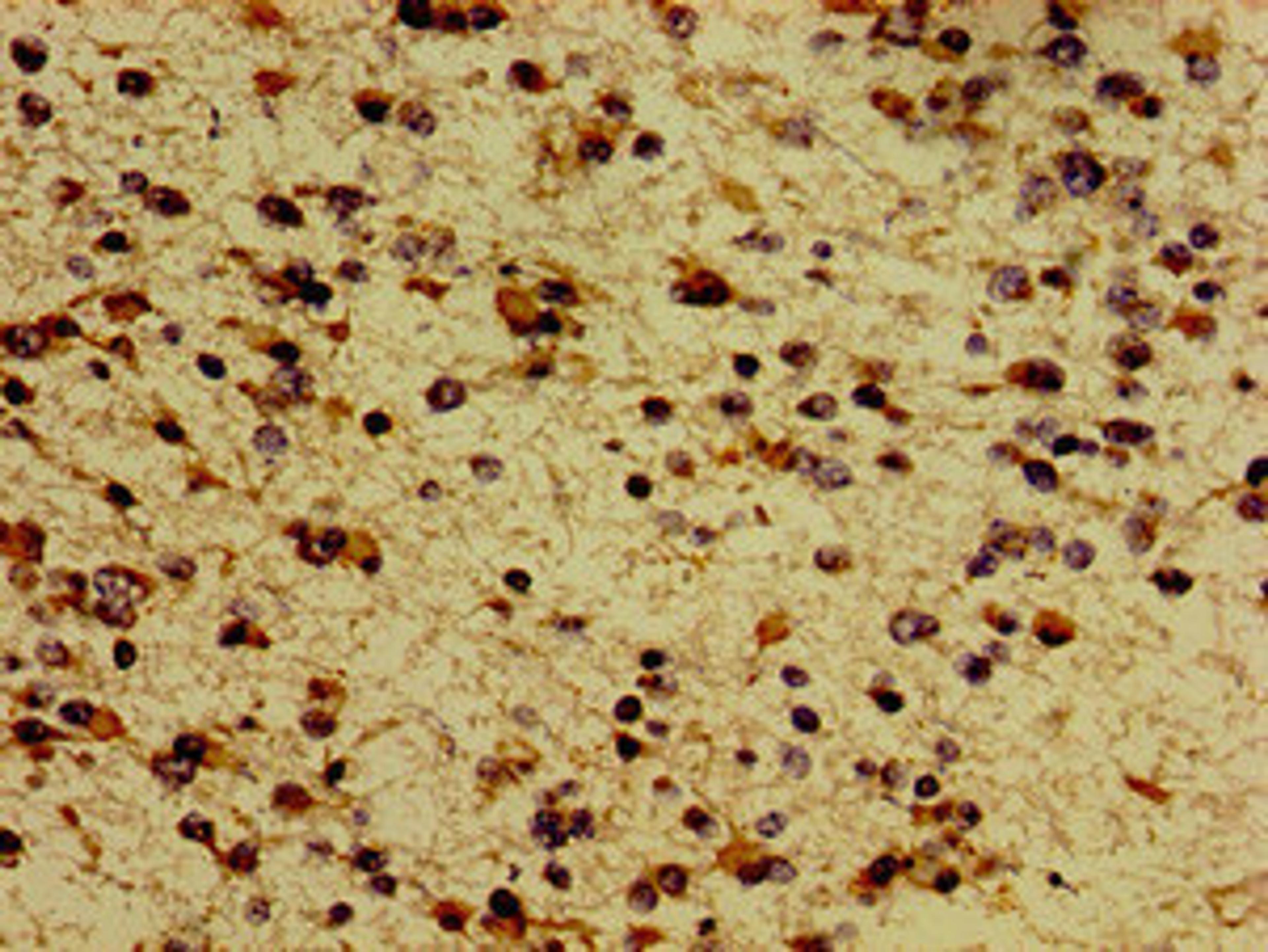 Immunohistochemistry of paraffin-embedded human glioma using CSB-PA013562LA01HU at dilution of 1:100