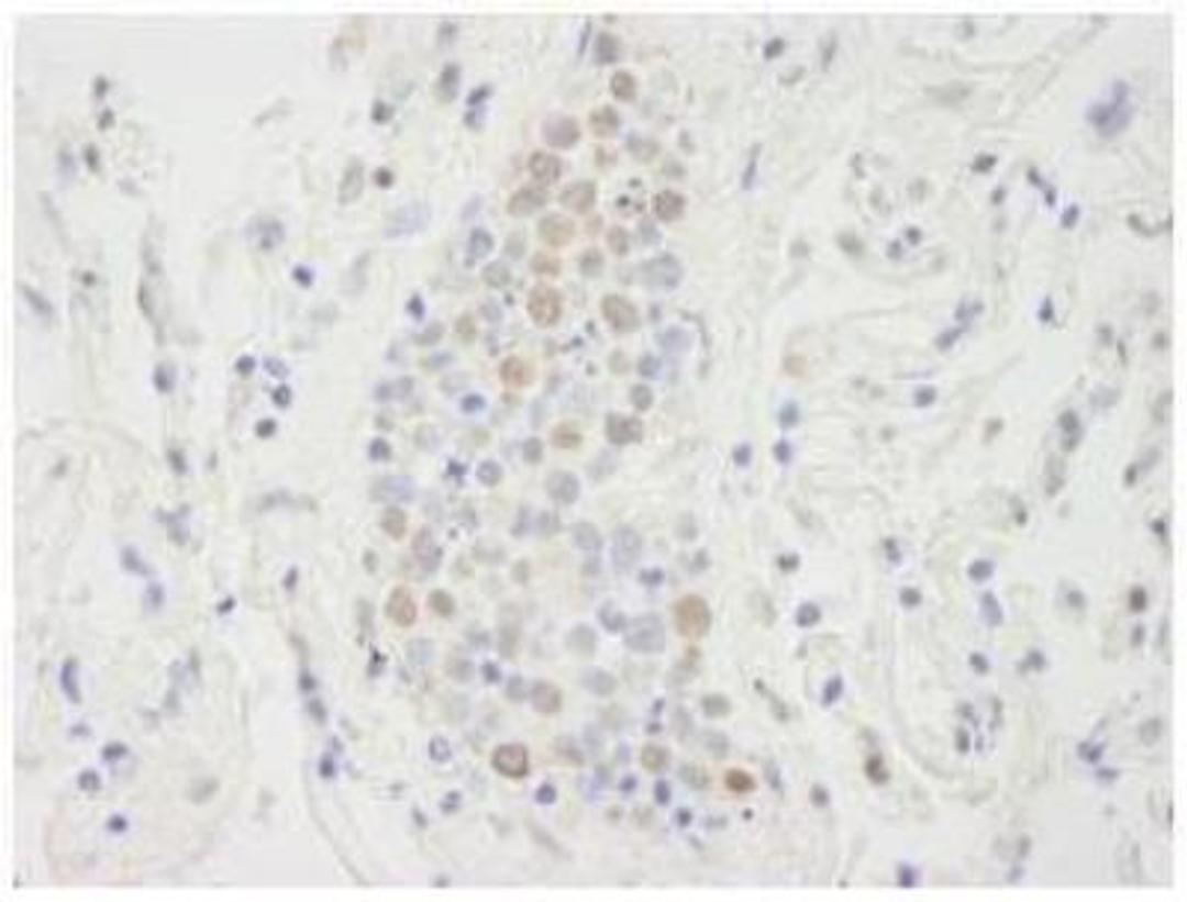 Immunohistochemistry-Paraffin: Spt6 Antibody [NB100-2582] - FFPE section of human small cell lung cancer..