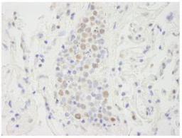 Immunohistochemistry-Paraffin: Spt6 Antibody [NB100-2582] - FFPE section of human small cell lung cancer..