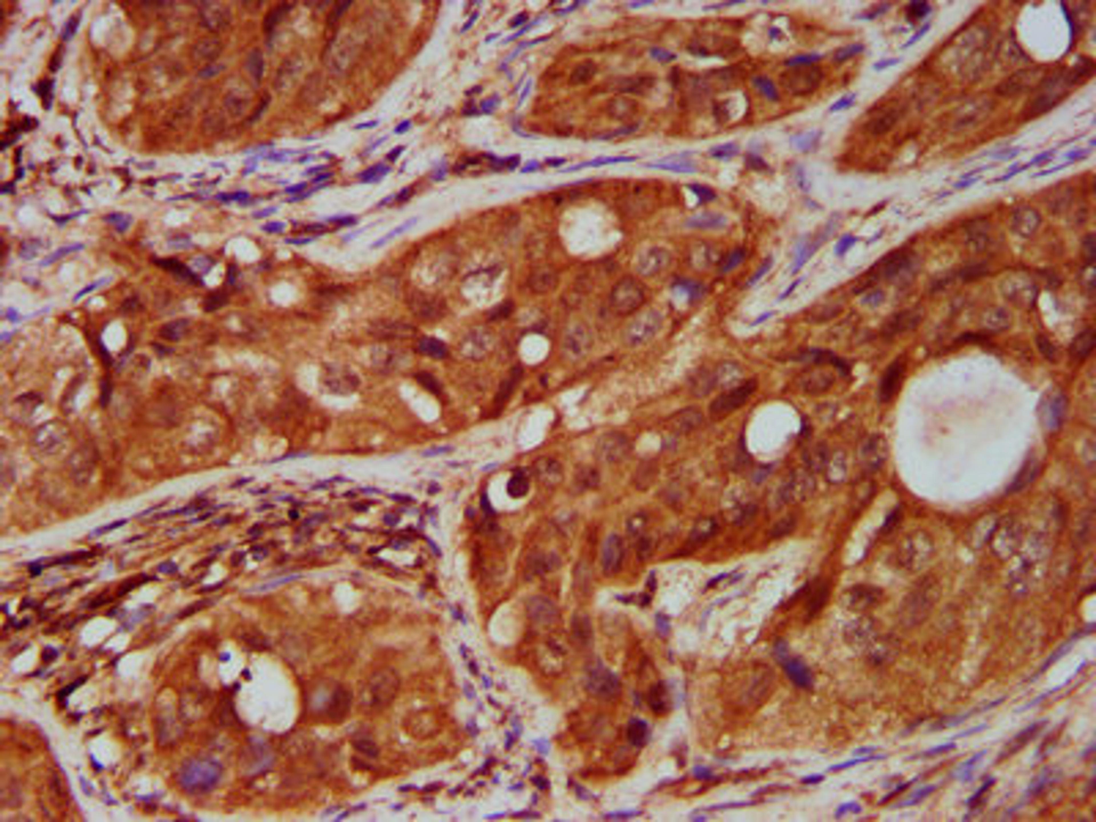 IHC image of CSB-PA023975LA01HU diluted at 1:500 and staining in paraffin-embedded human cervical cancer performed on a Leica BondTM system. After dewaxing and hydration, antigen retrieval was mediated by high pressure in a citrate buffer (pH 6.0). Section was blocked with 10% normal goat serum 30min at RT. Then primary antibody (1% BSA) was incubated at 4°C overnight. The primary is detected by a biotinylated secondary antibody and visualized using an HRP conjugated SP system.