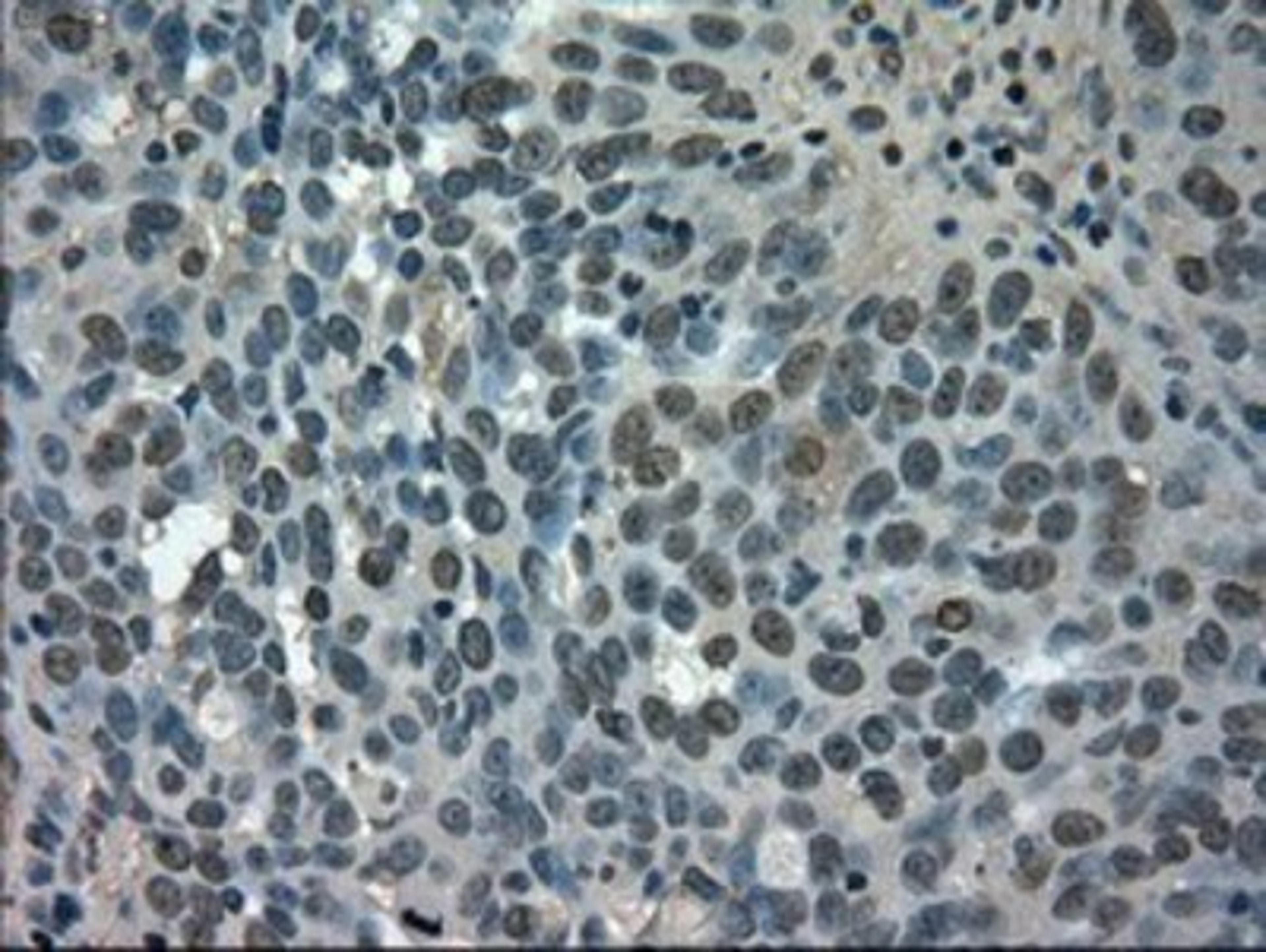 Immunohistochemistry-Paraffin: Glucose Transporter GLUT5 Antibody (9F3) [NBP1-47980] - Staining of paraffin-embedded Adenocarcinoma of Human ovary tissue using anti-Glucose Transporter GLUT5 mouse monoclonal antibody.