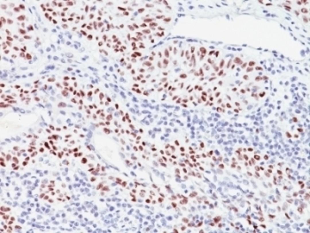 Formalin-fixed, paraffin-embedded human bladder carcinoma stained with p57 antibody (57P06).