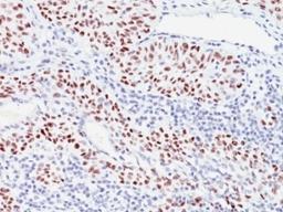 Formalin-fixed, paraffin-embedded human bladder carcinoma stained with p57 antibody (57P06).