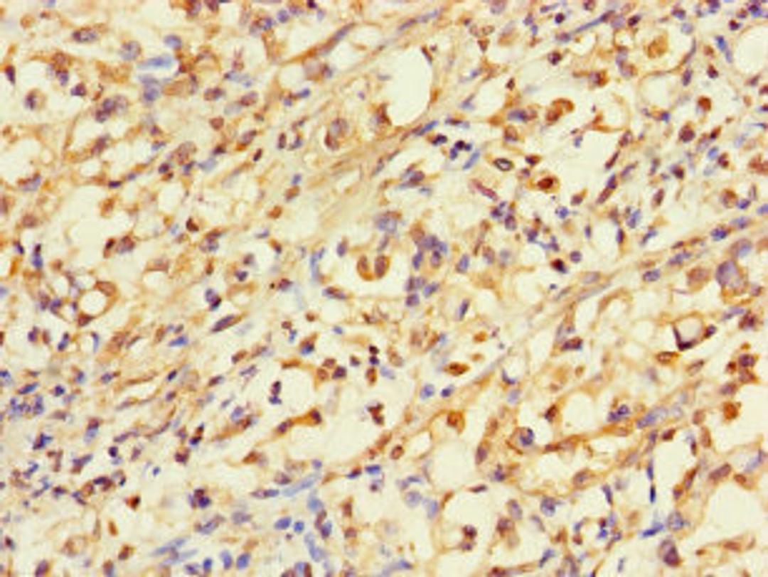 Immunohistochemistry of paraffin-embedded human gastric cancer using CSB-PA001158LA01HU at dilution of 1:100