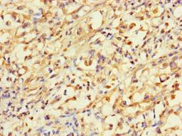 Immunohistochemistry of paraffin-embedded human gastric cancer using CSB-PA001158LA01HU at dilution of 1:100