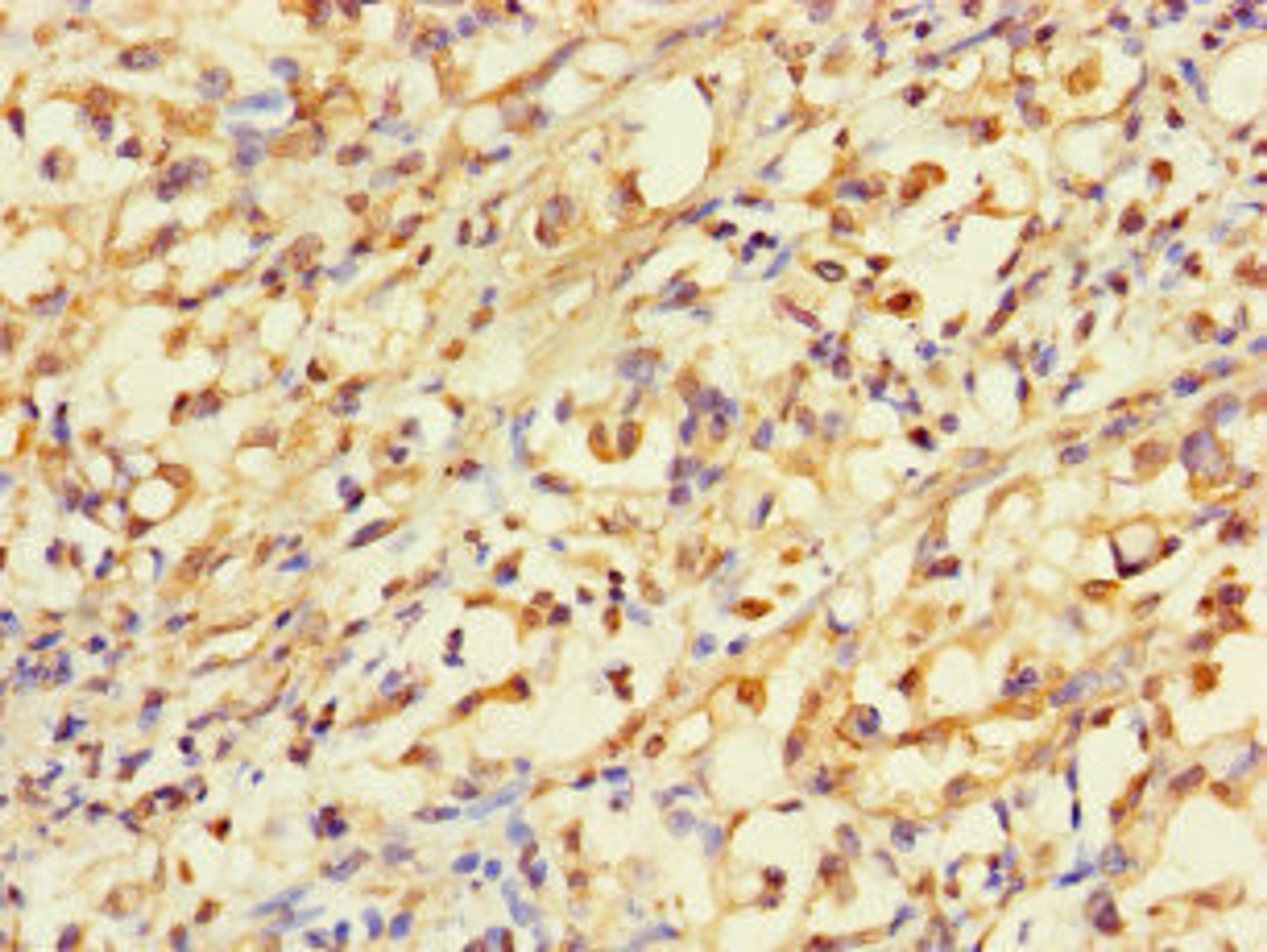 Immunohistochemistry of paraffin-embedded human gastric cancer using CSB-PA001158LA01HU at dilution of 1:100