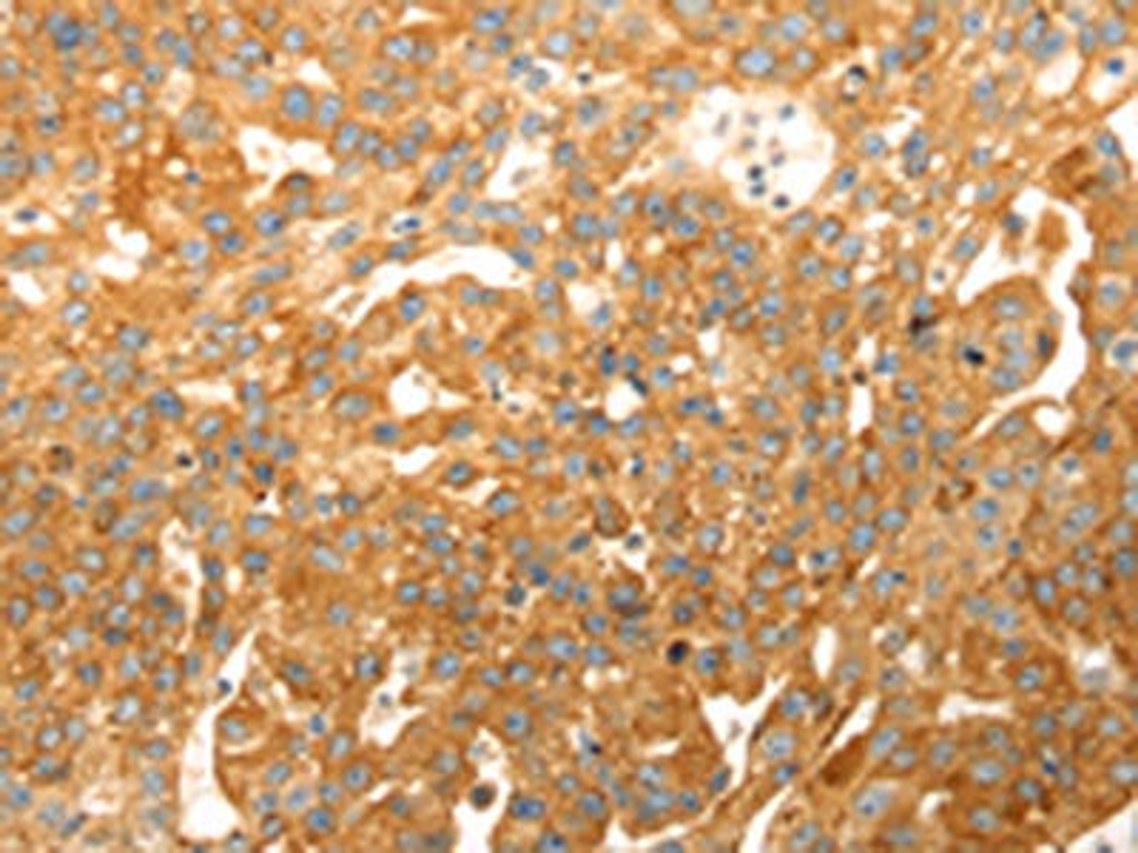 The image on the left is immunohistochemistry of paraffin-embedded Human breast cancer tissue using CSB-PA445743(CAPN1 Antibody) at dilution 1/20, on the right is treated with fusion protein. (Original magnification: ×200)