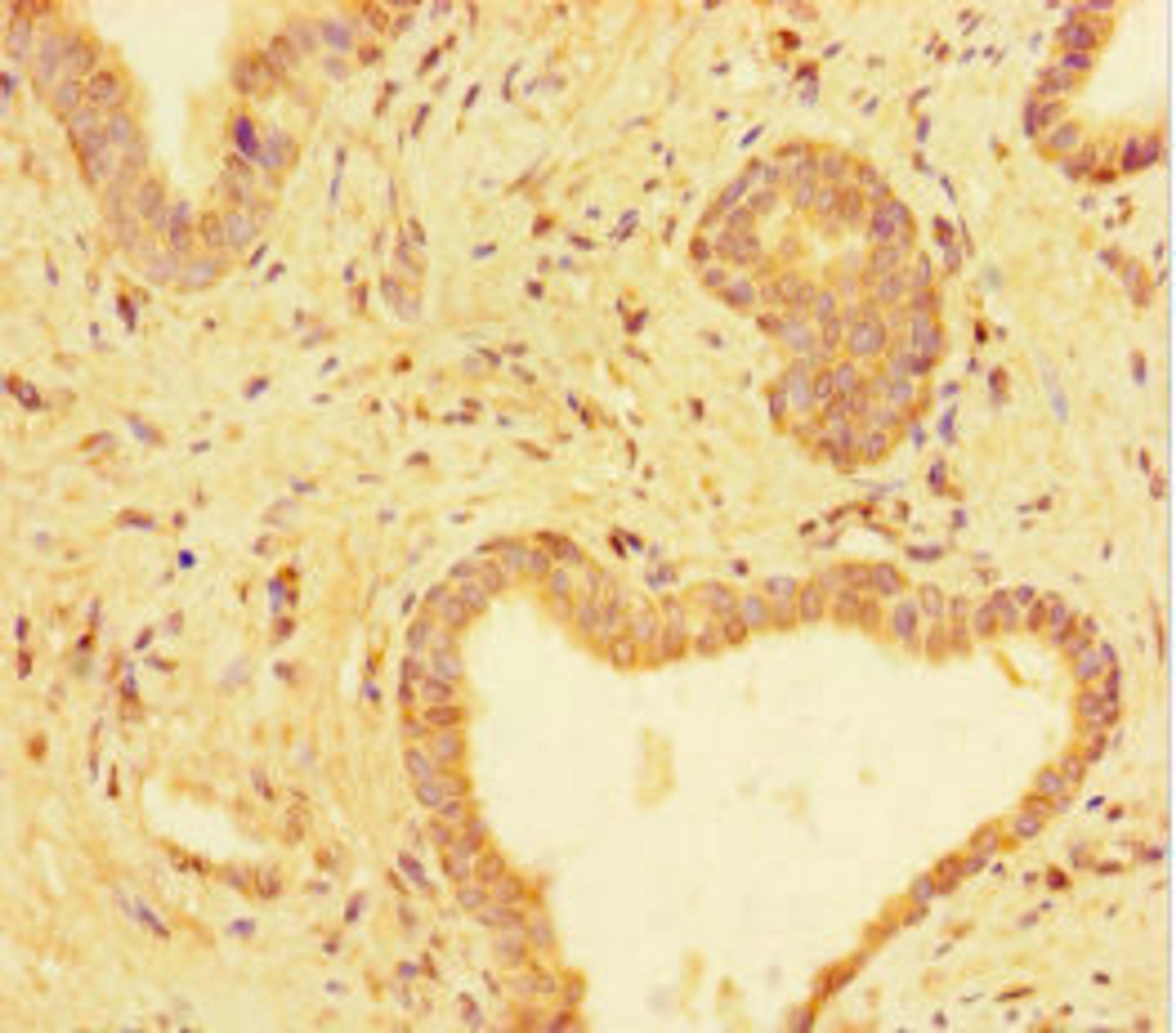 Immunohistochemistry of paraffin-embedded human prostate cancer using CSB-PA025308HA01HU at dilution of 1:100