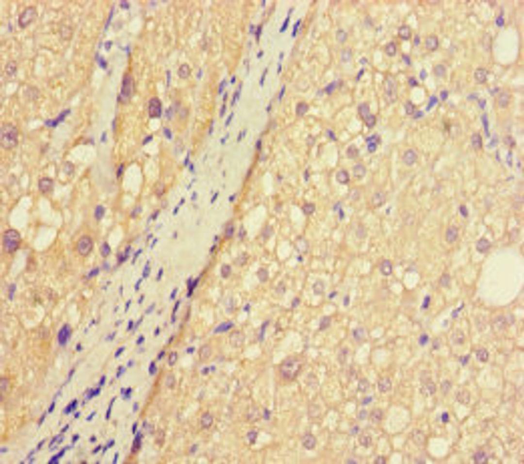 Immunohistochemistry of paraffin-embedded human liver cancer using CSB-PA845168LA01HU at dilution of 1:100