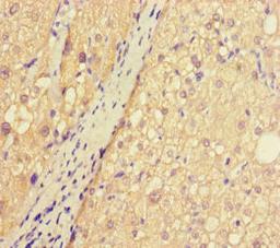 Immunohistochemistry of paraffin-embedded human liver cancer using CSB-PA845168LA01HU at dilution of 1:100