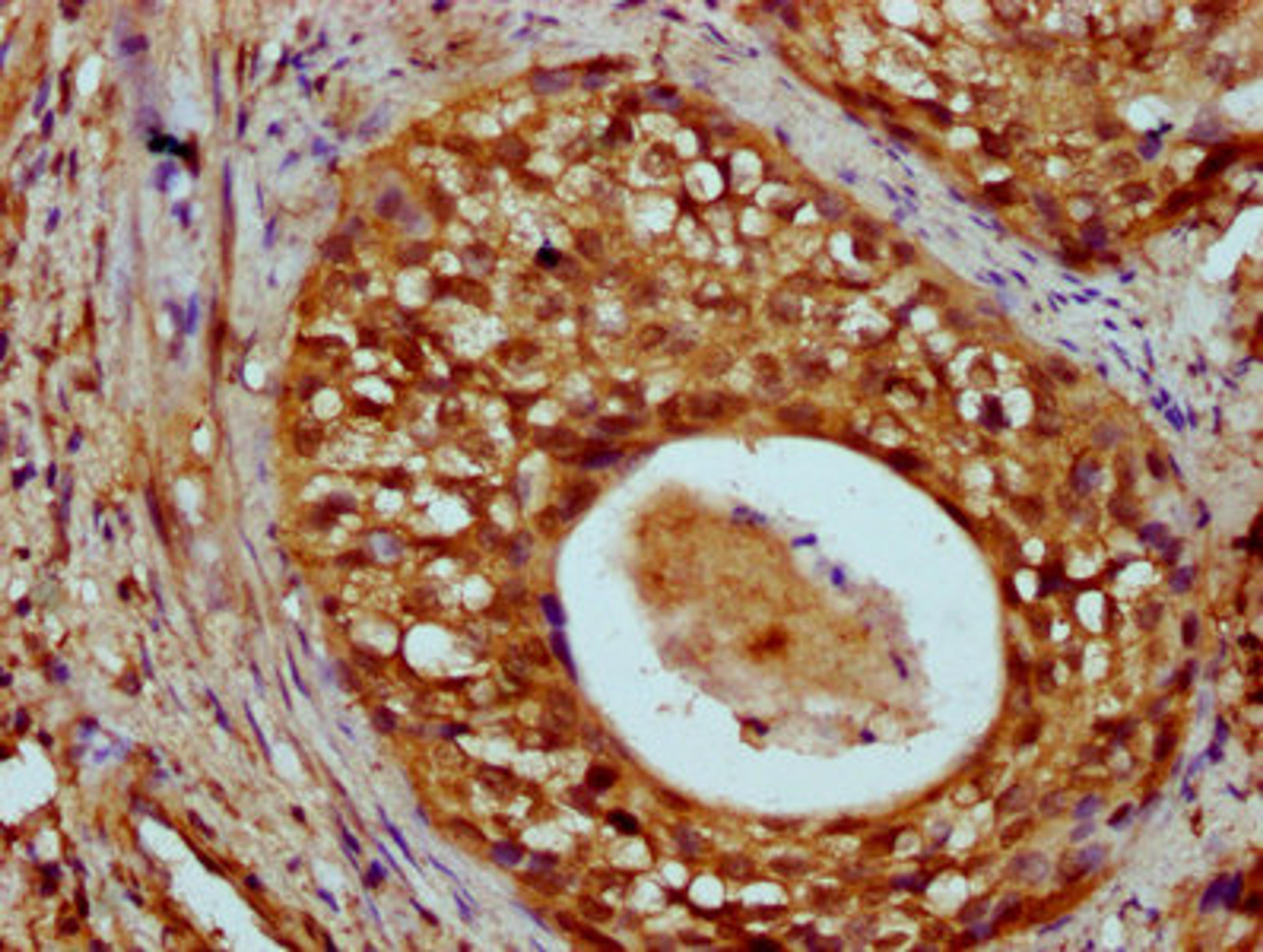 IHC image of CSB-PA010429OA55nme1HU diluted at 1:20 and staining in paraffin-embedded human cervical cancer performed on a Leica BondTM system. After dewaxing and hydration, antigen retrieval was mediated by high pressure in a citrate buffer (pH 6.0). Section was blocked with 10% normal goat serum 30min at RT. Then primary antibody (1% BSA) was incubated at 4&deg;C overnight. The primary is detected by a biotinylated secondary antibody and visualized using an HRP conjugated SP system.