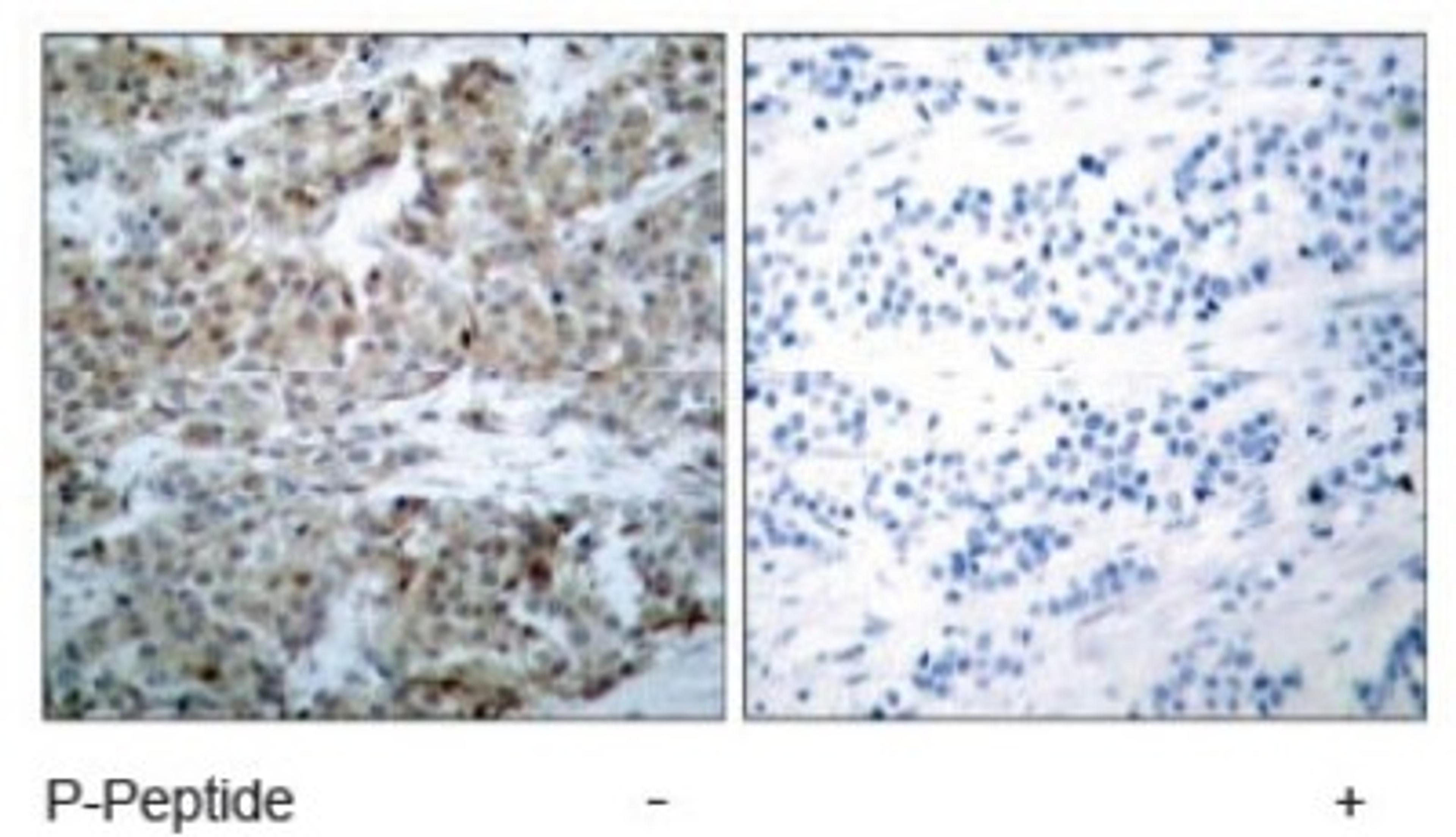 Immunohistochemistry: Bad [p Ser112] Antibody [NB100-81807] - Immunohistochemical analysis of paraffin-embedded human breast carcinoma tissue using BAD (phospho-Ser112) NB100-81807