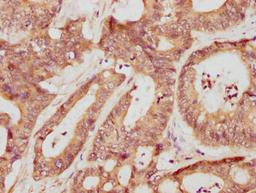 IHC image of CSB-PA17509A0Rb diluted at 1:709 and staining in paraffin-embedded human colon cancer performed on a Leica BondTM system. After dewaxing and hydration, antigen retrieval was mediated by high pressure in a citrate buffer (pH 6.0). Section was blocked with 10% normal goat serum 30min at RT. Then primary antibody (1% BSA) was incubated at 4°C overnight. The primary is detected by a biotinylated secondary antibody and visualized using an HRP conjugated SP system.
