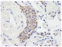 Immunohistochemistry-Paraffin: TOP2B Antibody [NB100-40842] - FFPE section of human small cell lung cancer.  Affinity purified rabbit anti-Topo II Beta used at a dilution of 1:250.