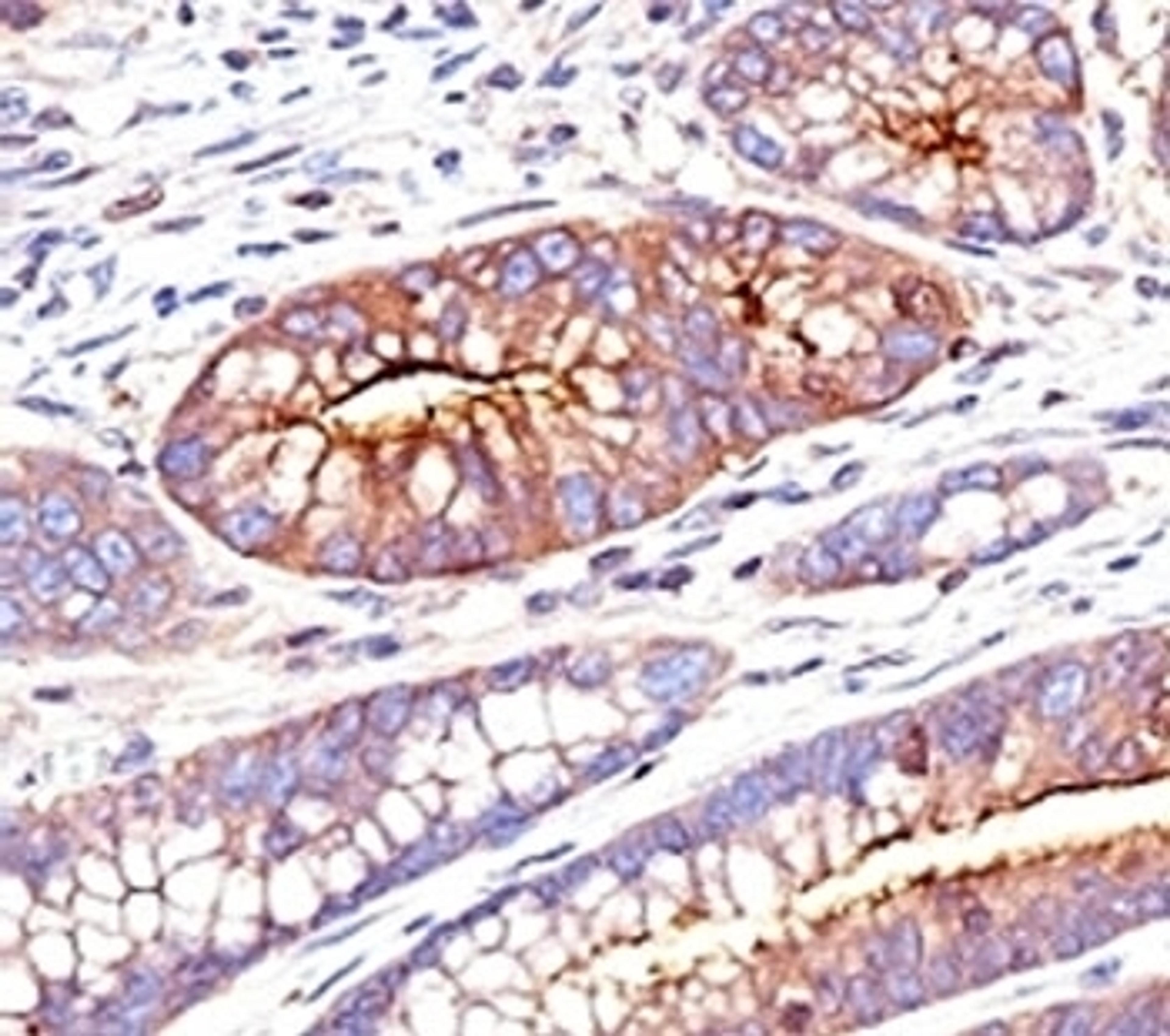 Formalin-fixed, paraffin-embedded human colon carcinoma stained with CEA antibody (SPM551)