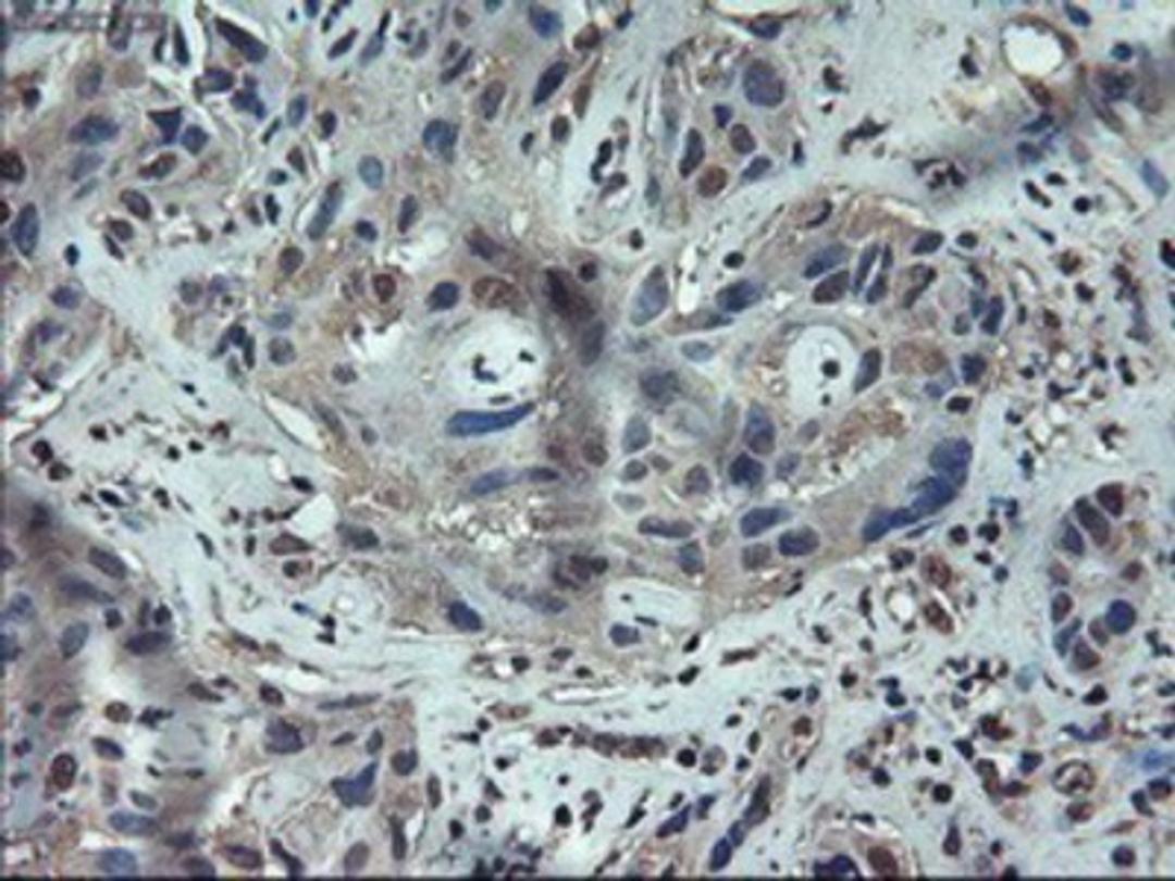 Immunohistochemistry-Paraffin: Apolipoprotein M Antibody (3H3) [NBP1-47660] - Staining of paraffin-embedded Carcinoma of liver using anti-Apolipoprotein M mouse monoclonal antibody.