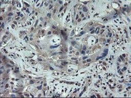 Immunohistochemistry-Paraffin: Apolipoprotein M Antibody (3H3) [NBP1-47660] - Staining of paraffin-embedded Carcinoma of liver using anti-Apolipoprotein M mouse monoclonal antibody.