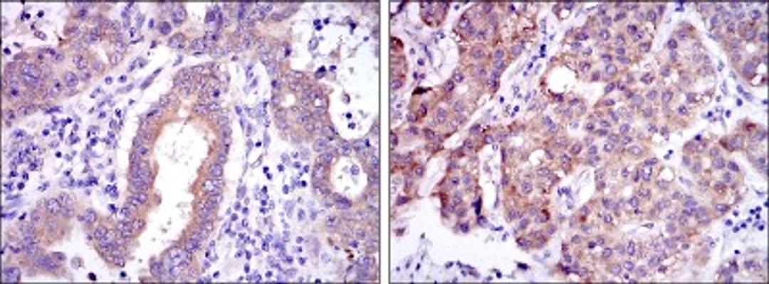 Immunohistochemistry: c-Rel Antibody (1E7) [NBP2-37593] - Immunohistochemical analysis of paraffin-embedded endometrial cancer tissues (left) and liver cancer tissues (right) using c-Rel mouse mAb with DAB staining.