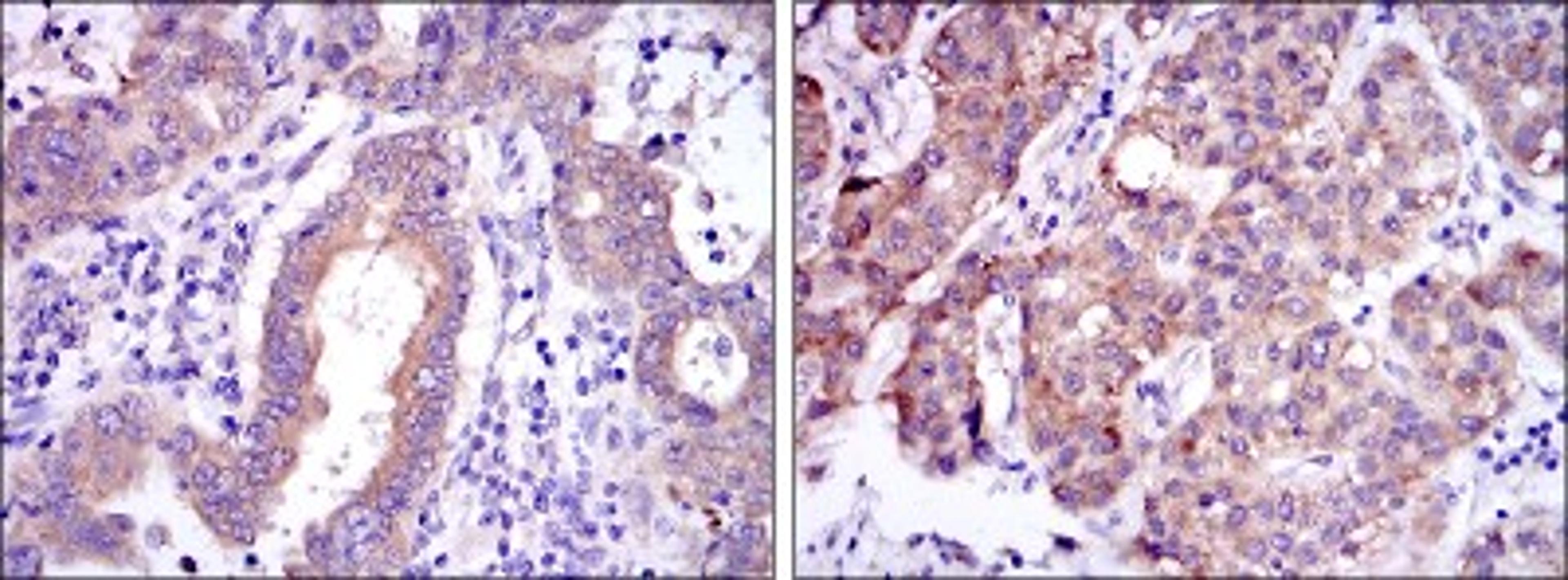 Immunohistochemistry: c-Rel Antibody (1E7) [NBP2-37593] - Immunohistochemical analysis of paraffin-embedded endometrial cancer tissues (left) and liver cancer tissues (right) using c-Rel mouse mAb with DAB staining.