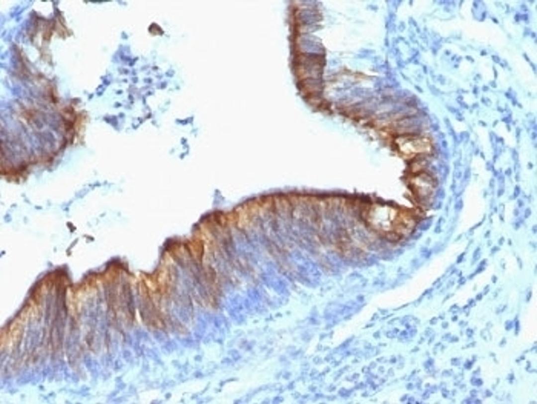 Formalin-fixed, paraffin-embedded human lung carcinoma stained with Keratin 8 antibody (KRT8/899).