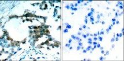 Immunohistochemical analysis ofparaffn-embedded human lungcarcinoma tissue using PKC??Phospho-Ser695?Antibody orb14884?left? or the same antibodypreincubated with blocking peptide?right?.