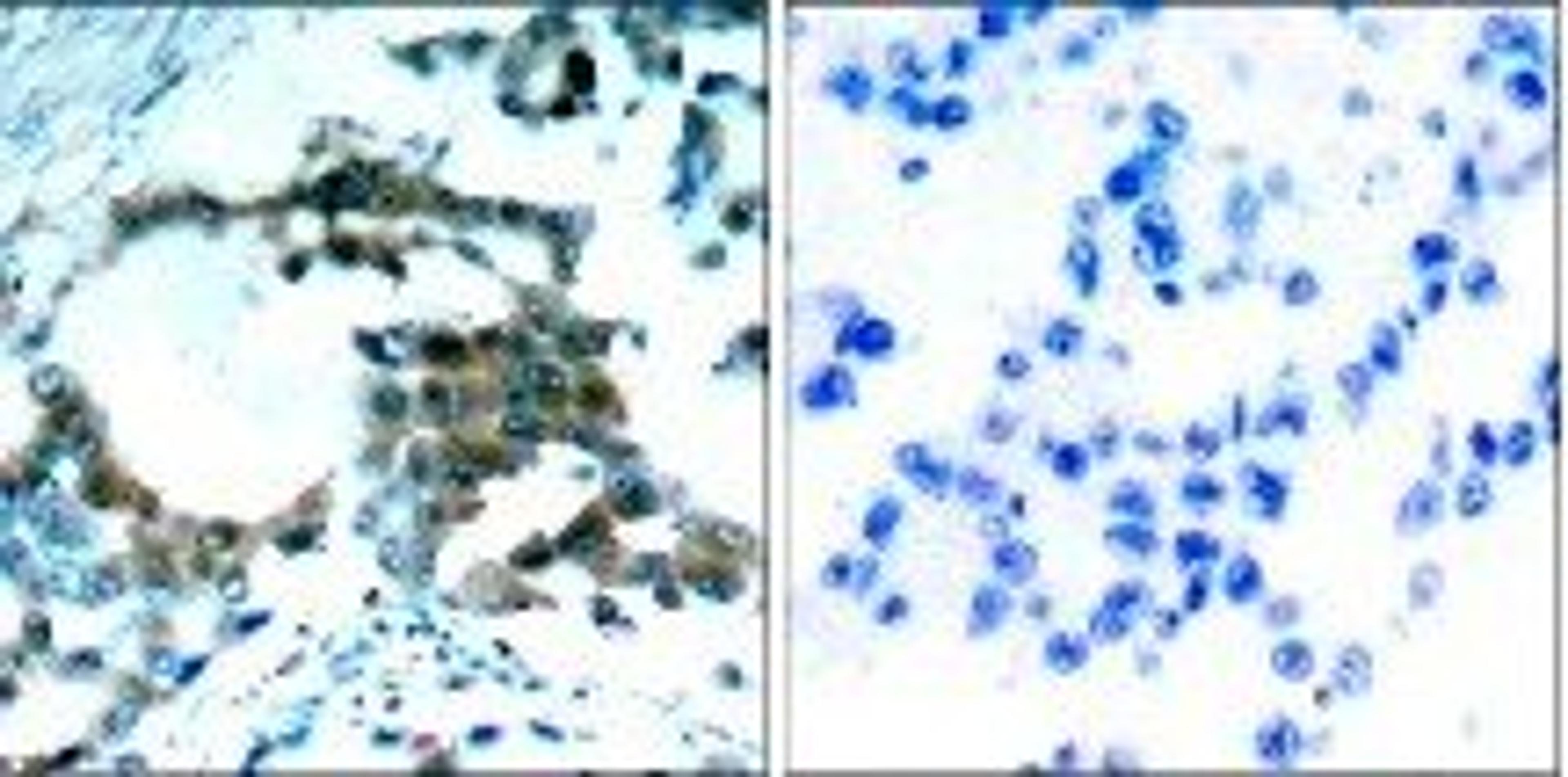 Immunohistochemical analysis ofparaffn-embedded human lungcarcinoma tissue using PKC??Phospho-Ser695?Antibody orb14884?left? or the same antibodypreincubated with blocking peptide?right?.