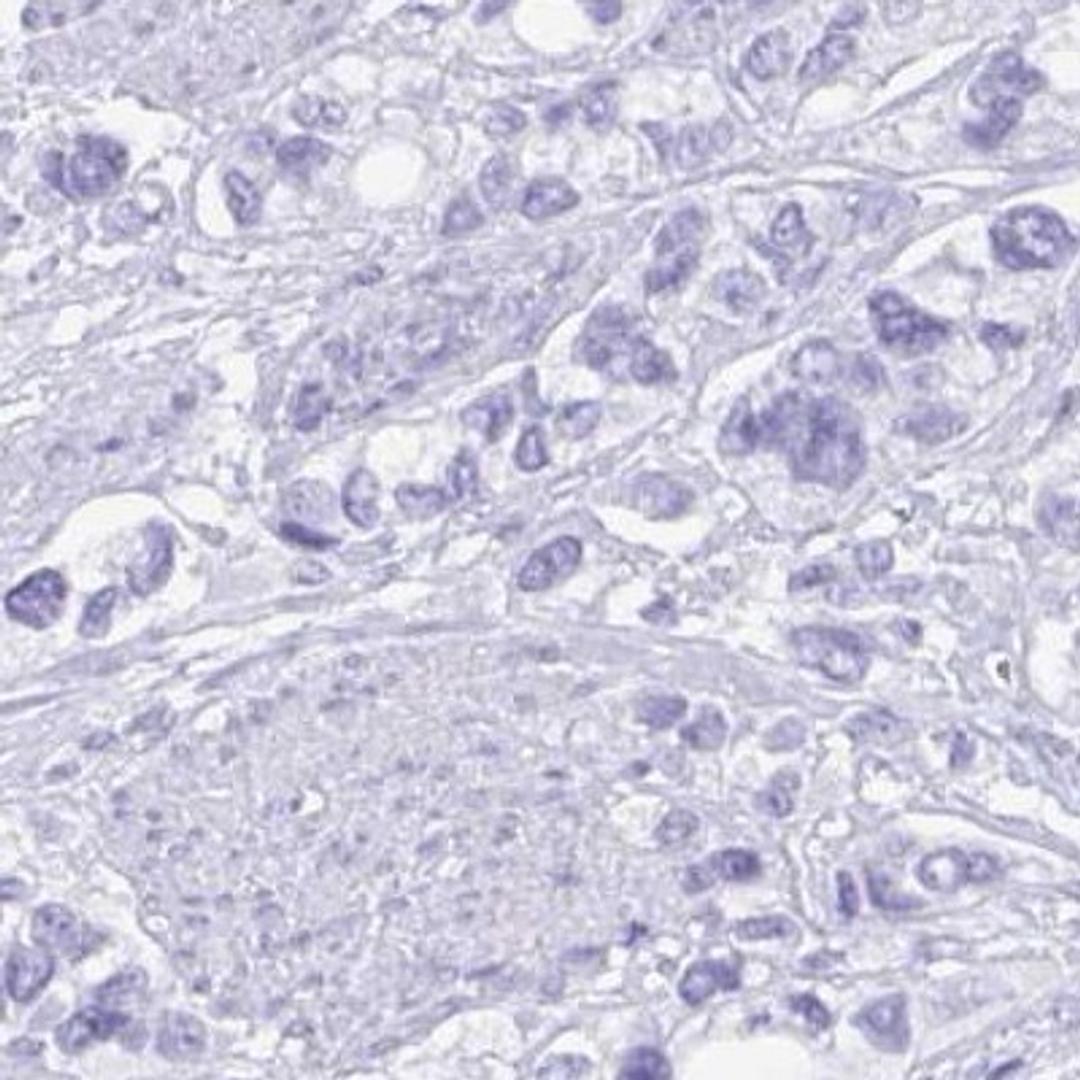 Immunohistochemistry: Gastrokine 2 Antibody [NBP2-31688] - stomach cancer