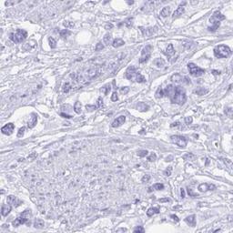 Immunohistochemistry: Gastrokine 2 Antibody [NBP2-31688] - stomach cancer