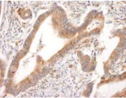 Immunohistochemistry-Paraffin: PML Protein Antibody [NB100-59787] - Section of human prostate carcinoma.