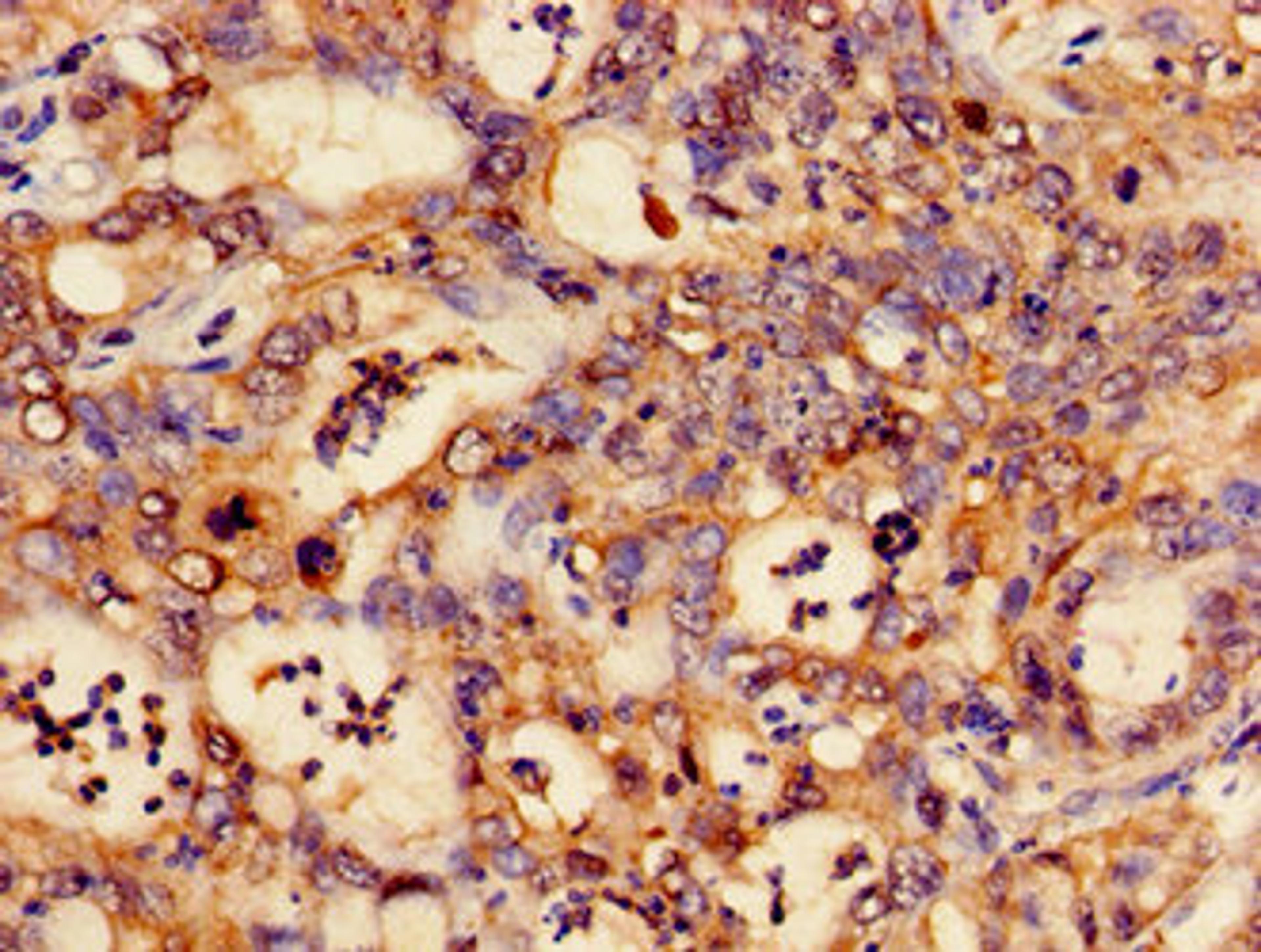 Immunohistochemistry of paraffin-embedded human liver cancer using CSB-PA006172LA01HU at dilution of 1:100