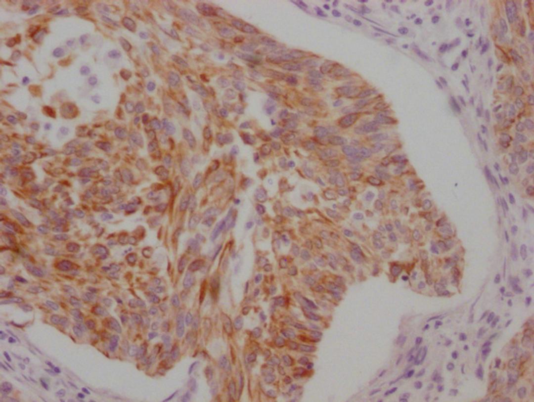 IHC image of CSB-MA898464 diluted at 1:100 and staining in paraffin-embedded human cervical cancer performed on a Leica BondTM system. After dewaxing and hydration, antigen retrieval was mediated by high pressure in a citrate buffer (pH 6.0). Section was blocked with 10% normal goat serum 30min at RT. Then primary antibody (1% BSA) was incubated at 4°C overnight. The primary is detected by a Goat anti-mouse IgG polymer labeled by HRP and visualized using 0.05% DAB.